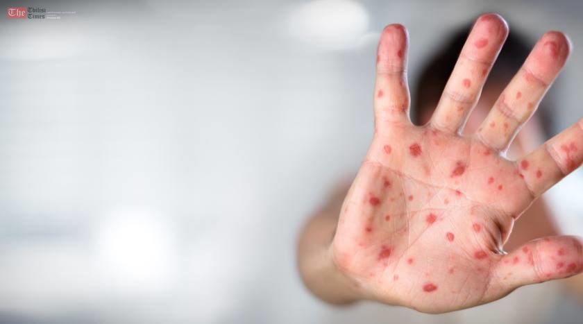 ,,წითელასგან მხოლოდ ვაქცინაცია დაგიცავთ!“ – პედიატრი ინგა მამუჩიშვილი