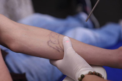 ტატუს მოშორება- გზა რესოციალიზაციის წარმატებამდე?