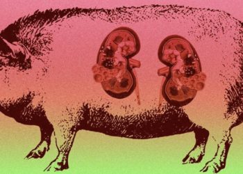 მეცნიერებმა ღორის თირკმელი ადამიანს გადაუნერგეს!