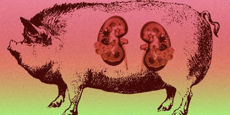 მეცნიერებმა ღორის თირკმელი ადამიანს გადაუნერგეს!