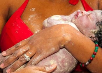 უიშვიათესი სამედიცინო შემთხვევა — ბრაზილიაში კუდის მქონე ბავშვი დაიბადა