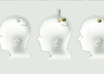 ილონ მასკი: Neuralink-ის ჩიპების ადამიანებზე გამოცდა შესაძლოა, 2022 წლიდან დაიწყოს