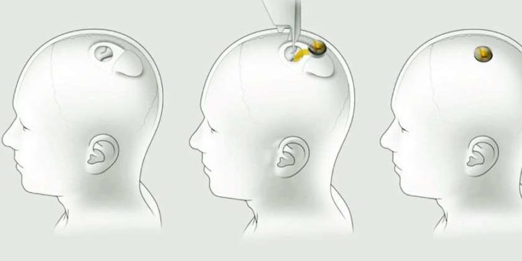 ილონ მასკი: Neuralink-ის ჩიპების ადამიანებზე გამოცდა შესაძლოა, 2022 წლიდან დაიწყოს