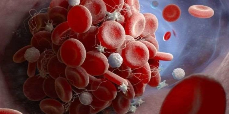 მეცნიერები – COVID-19-ის აცრის შემდეგ თრომბის ჩამოყალიბების მიზეზი დადგენილია