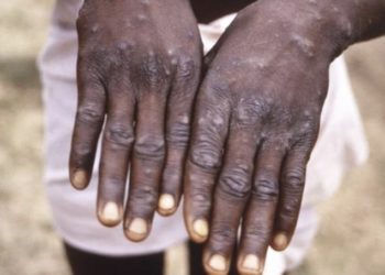 ჯანმო მაიმუნის ყვავილთან დაკავშირებით განცხადებას ავრცელებს 