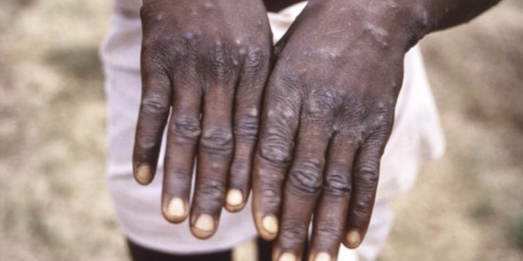 ჯანმო მაიმუნის ყვავილთან დაკავშირებით განცხადებას ავრცელებს 