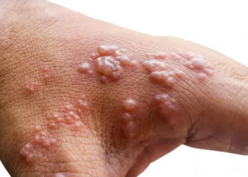 მაიმუნის ჩუტყვავილის სიმპტომები 