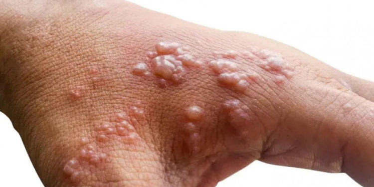 მაიმუნის ჩუტყვავილის სიმპტომები