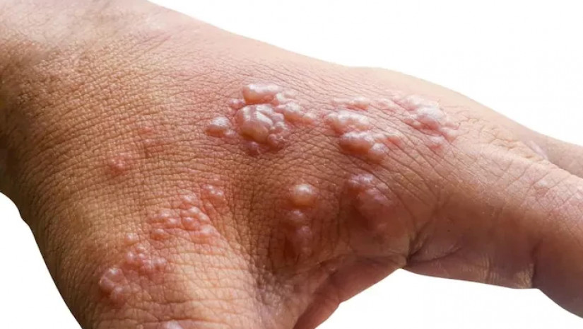 მაიმუნის ჩუტყვავილის სიმპტომები