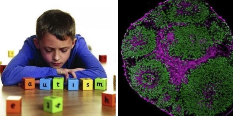 აუტიზმთან დაკავშირებული მუტირებული გენი წარმატებით აღადგინეს