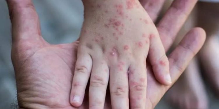 “მაიმუნის ყვავილთან” გასამკლავებლად ქართული ჯანდაცვა მზად არის” – მაკა ბულეიშვილი