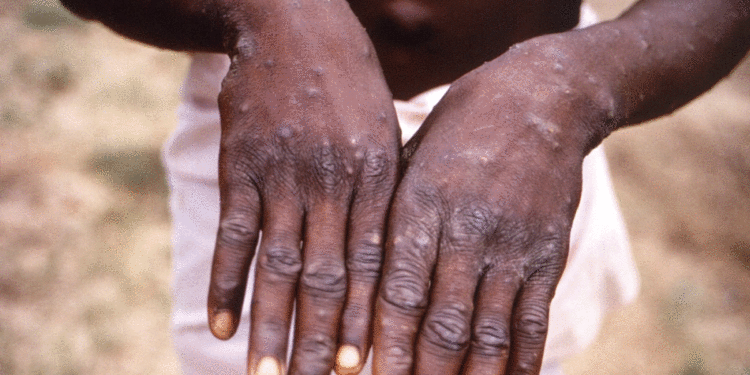 ჯანდაცვის მსოფლიო ქსელმა მაიმუნის ყვავილი პანდემიად გამოაცხადა – ჯანმოს პოზიცია ჯერ უცნობია