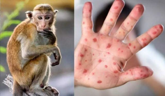 საქართველოში „მაიმუნის ყვავილის“ პირველი შემთხვევა დადასტურდა