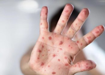 ინდოეთში ახალი ვირუსი ე.წ. „პომიდვრის გრიპი“ გავრცელდა