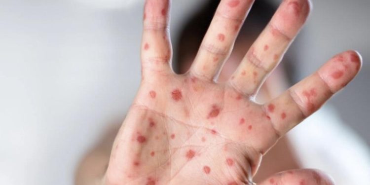 ინდოეთში ახალი ვირუსი ე.წ. „პომიდვრის გრიპი“ გავრცელდა