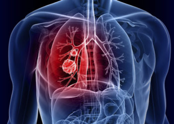 ექსპერიმენტული პრეპარატი, რომელიც ფილტვის კიბოს უმძიმეს ფორმას აჩერებს – მეცნიერების მორიგი სენსაციური მიღწევა