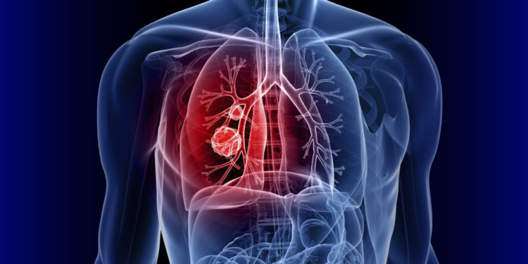 ექსპერიმენტული პრეპარატი, რომელიც ფილტვის კიბოს უმძიმეს ფორმას აჩერებს – მეცნიერების მორიგი სენსაციური მიღწევა