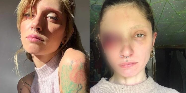 „ცრემლის ნაცვლად თვალიდან სისხლი მდის“ – რას ჰყვება ძალადობის მსხვერპლი ქალი