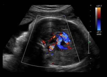 პირველად მსოფლიოში – ნაყოფს თავის ტვინის ოპერაცია, დაბადებამდე, საშვილოსნოში ჩაუტარეს