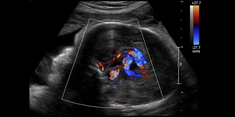 პირველად მსოფლიოში – ნაყოფს თავის ტვინის ოპერაცია, დაბადებამდე, საშვილოსნოში ჩაუტარეს