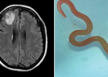მსოფლიოში პირველად, ავსტრალიელი ქალის ტვინში ცოცხალი ჭია აღმოაჩინეს