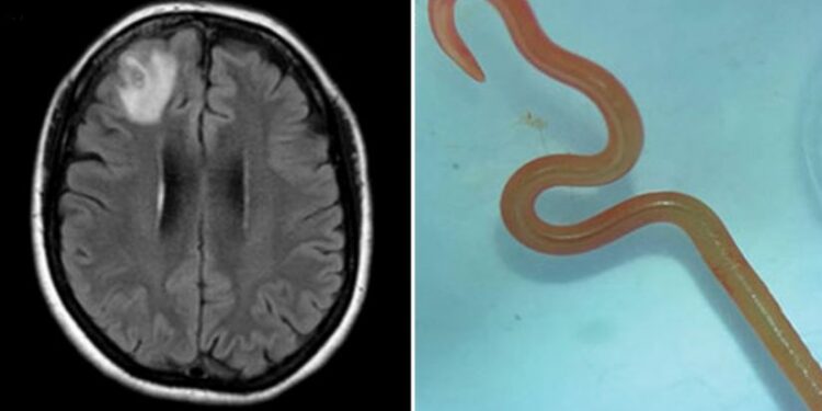 მსოფლიოში პირველად, ავსტრალიელი ქალის ტვინში ცოცხალი ჭია აღმოაჩინეს