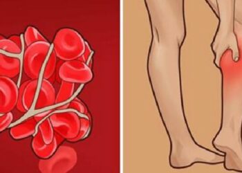 რა სიმპტომები ახასიათებს სისხლძარღვების თრომბს და როგორ უნდა გადავჭრათ მოცემული პრობლემა