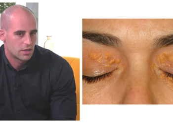 ცხიმგროვები თვალის არეში, სიშავე მუხლების, იდაყვისა და იღლიის მიდამოში… – ზაზა თელია განმარტავს, რა დაავადებებზე შეიძლება მიუთითებდეს კანზე არსებული დაზიანებები