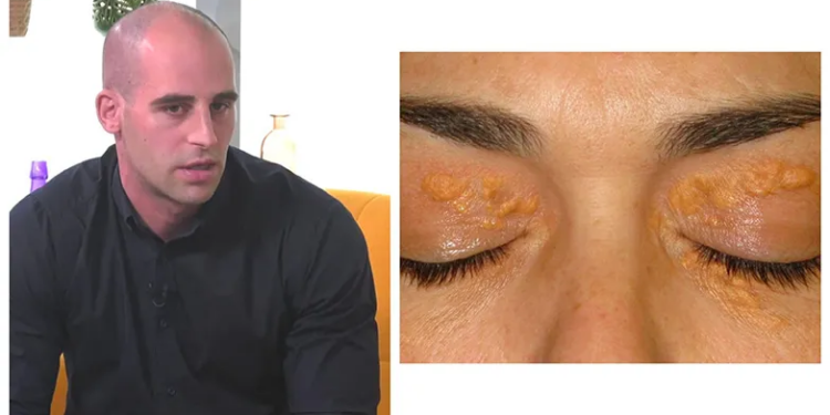 ცხიმგროვები თვალის არეში, სიშავე მუხლების, იდაყვისა და იღლიის მიდამოში… – ზაზა თელია განმარტავს, რა დაავადებებზე შეიძლება მიუთითებდეს კანზე არსებული დაზიანებები