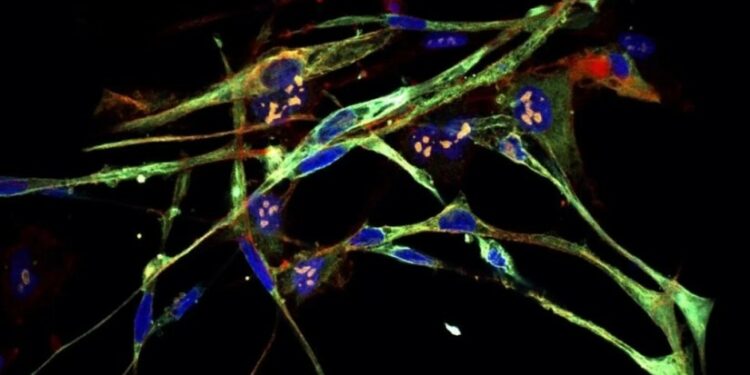 კარგი ამბავი! აგრესიული კიბოს უჯრედები მეცნიერებმა ჯანმრთელ უჯრედებად გარდაქმნეს