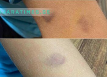 გავრცელებული ინფორმაციით, ბათუმში პირველკლასელს ტანსაცმელი გახადეს და მასზე ფიზიკურად იძალადეს