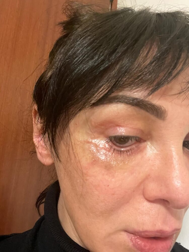 “კიდევ ორი ოპერაციაა საჭირო იმისთვის, რომ სახე აღვიდგინო“ – ვინ და რატომ უჩივის ციცინო შურღაიას?