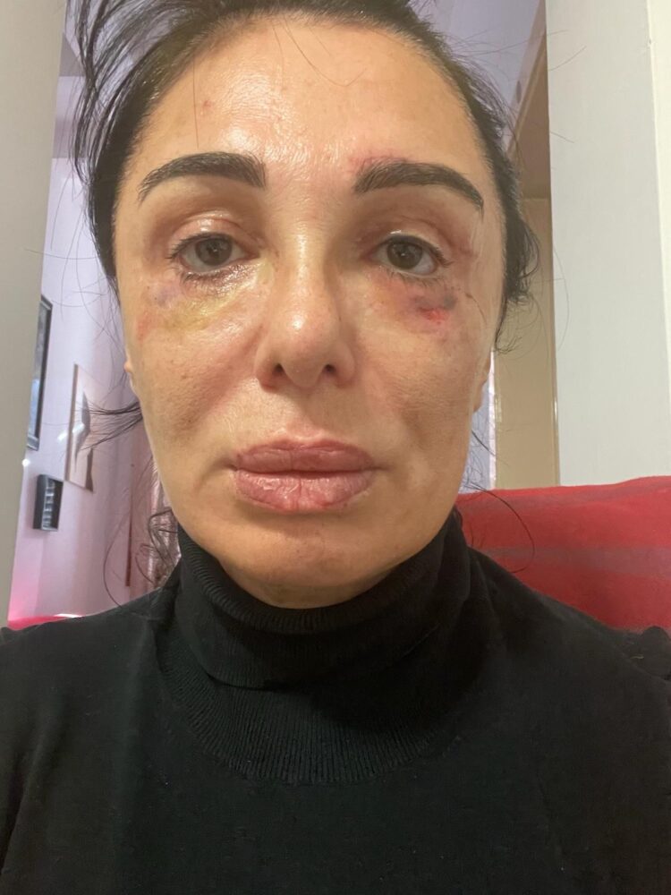 “კიდევ ორი ოპერაციაა საჭირო იმისთვის, რომ სახე აღვიდგინო“ – ვინ და რატომ უჩივის ციცინო შურღაიას?