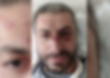 “პირდაპირ ჩემ სახეზე გაატარეთ აწი ევროპა” – აქციის დაშლის დროს დაშავებული მოქალაქე