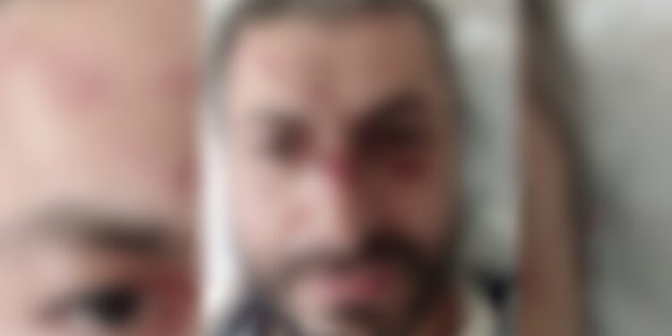 “პირდაპირ ჩემ სახეზე გაატარეთ აწი ევროპა” – აქციის დაშლის დროს დაშავებული მოქალაქე