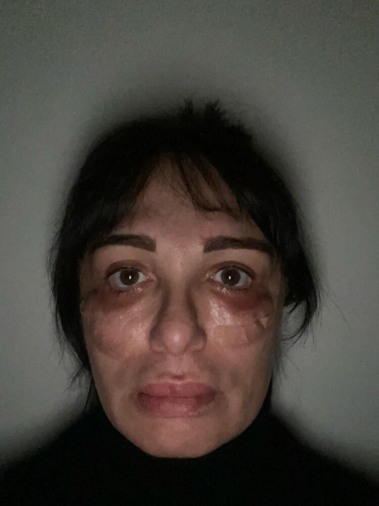 “კიდევ ორი ოპერაციაა საჭირო იმისთვის, რომ სახე აღვიდგინო“ – ვინ და რატომ უჩივის ციცინო შურღაიას?