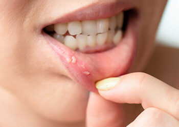 სტომატიტი: რა უნდა ვიცოდეთ და როგორ ვუმკურნალოთ?
